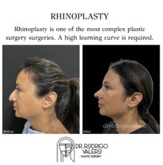 Rinoplastia - Dr. Rodrigo Valero Jarillo