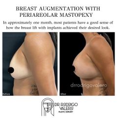 Aumento de busto - Dr. Rodrigo Valero Jarillo