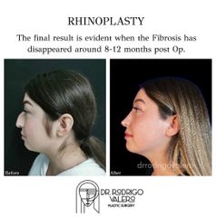 Rinoplastia - Dr. Rodrigo Valero Jarillo