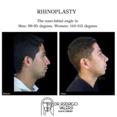 Rinoplastia - Dr. Rodrigo Valero Jarillo