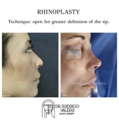 Rinoplastia - Dr. Rodrigo Valero Jarillo