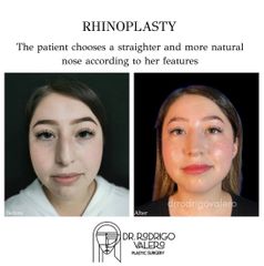 Rinoplastia - Dr. Rodrigo Valero Jarillo