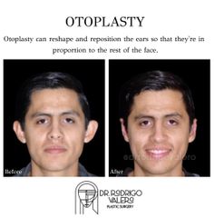 Otoplastia