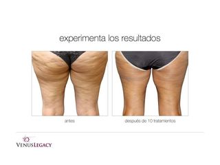 Antes y después de Tratamientos anticelulíticos