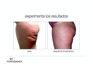 Antes y después de Tratamientos anticelulíticos