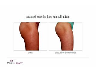Antes y después de Tratamientos anticelulíticos