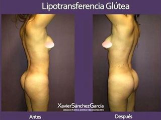 Antes y después de Gluteoplastia