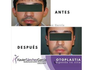 Antes y después de Otoplastia