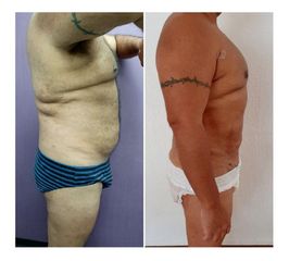 Antes y después de Liposucción Vaser