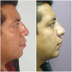 Antes y después de Rinoplastia + mentoplastia 