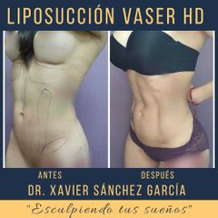 Antes y después de Lipoescultura
