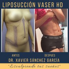 Antes y después de Liposucción Vaser HD 