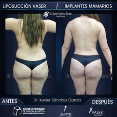 Liposucción - Dr. Xavier Sánchez García