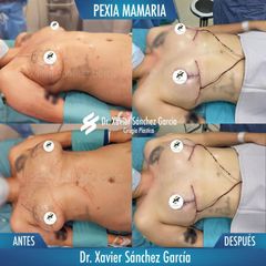 Mastopexia - Dr. Xavier Sánchez García