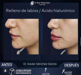 Relleno Ácido hialurónico Labios - Dr. Xavier Sánchez García