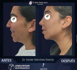 Rinoplastia - Dr. Xavier Sánchez García