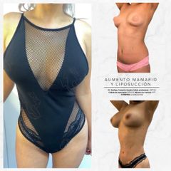 Antes y después de Liposucción  y Aumento mamario