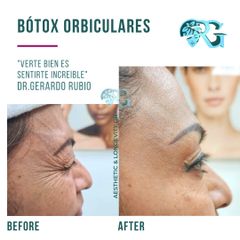 Bótox Orbiculares - Dr. Gerardo Rubio
