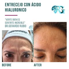 Ácido Hialurónico Entrecejo - Dr. Gerardo Rubio