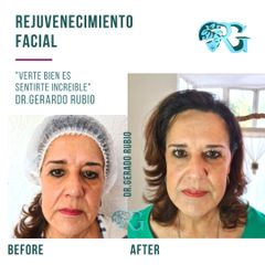 Rejuvenecimiento Facial - Dr. Gerardo Rubio