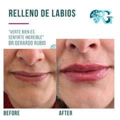 Relleno de Labios - Dr. Gerardo Rubio