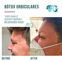 Bótox Orbiculares o Patas de Gallo