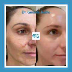 Cosmelan Peel