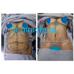 Antes y después de Lipoabdominoplastia 