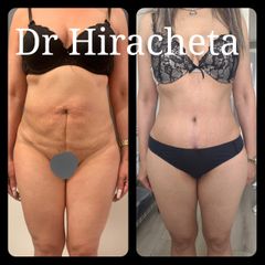 Antes y después de Abdominoplastia 