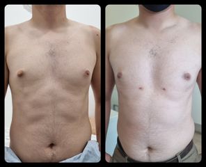 Antes y después de Ginecomastia 