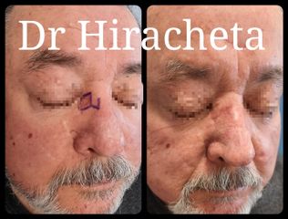 Antes y después de Carcinoma basocelular 