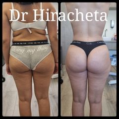 Antes y después de Gluteoplastia 