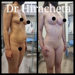 Antes y después de Mommy makeover 