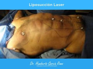 Resultado de Liposucción Laser