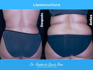 Antes y después de Lipoescultura