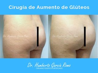 Antes y después de Aumento de Gluteos con Lipo Transferencia