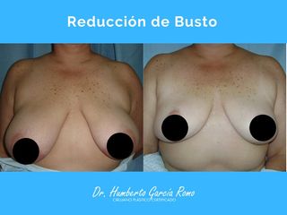 Antes y después de Reducción de busto