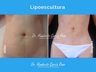 Antes y después de Lipoescultura
