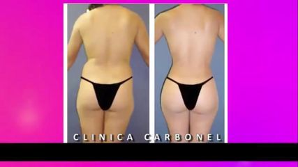 Antes y después de Aumento de Glúteos con Lipo Transferencia - Dr. Jorge Humberto García Romo