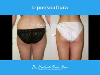Antes y después de Lipoescultura