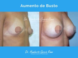 Antes y después de Aumento de Busto