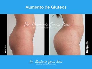 Antes y después de Aumento de glúteos