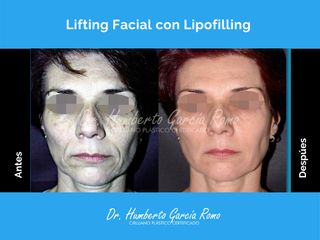 Lifting Facial con Lipofiling - Dr. Jorge Humberto García Romo