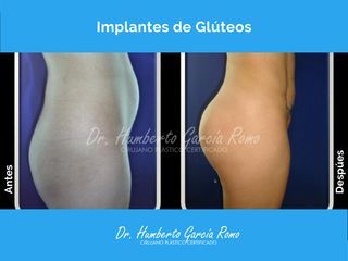 Gluteoplastia - Dr. Jorge Humberto García Romo