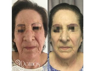 Tratamiento: AAPEcelulas madre en rostro antes y despues de la segunda sesión