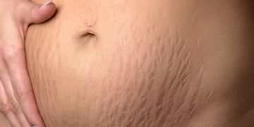 Cirugía estética posparto, una renovación deseada Cirugía estética posparto, una renovación deseada