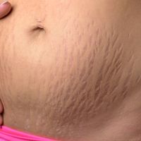 Cirugía estética posparto, una renovación deseada