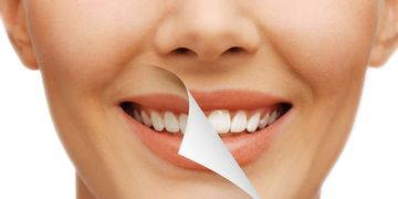 Los tres tipos de blanqueamiento dental más usados en Colombia