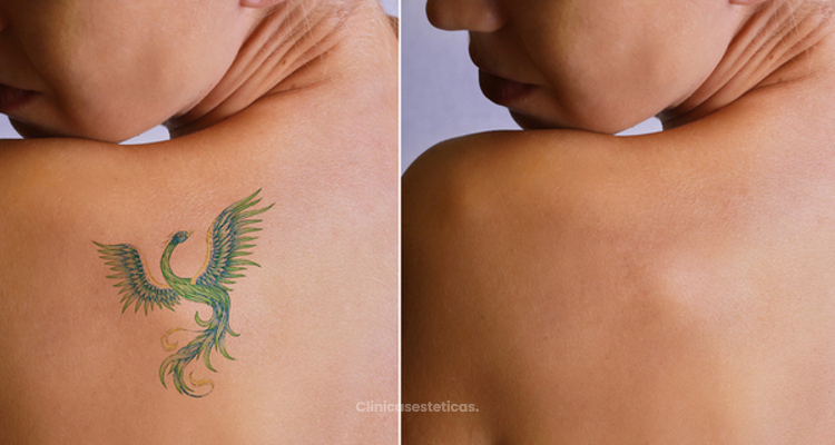 El Magic Pen: Lo último para la eliminación de tatuajes