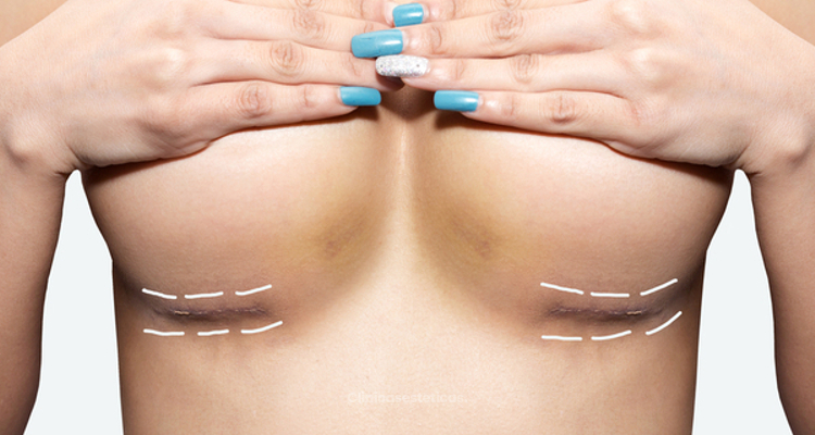 ¿Cómo es la cicatriz tras una cirugía de aumento de senos?